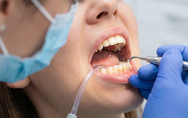 Diş Taşı Temizliği Zararlı Mı? (Doğru Bilinen Yanlışlar)