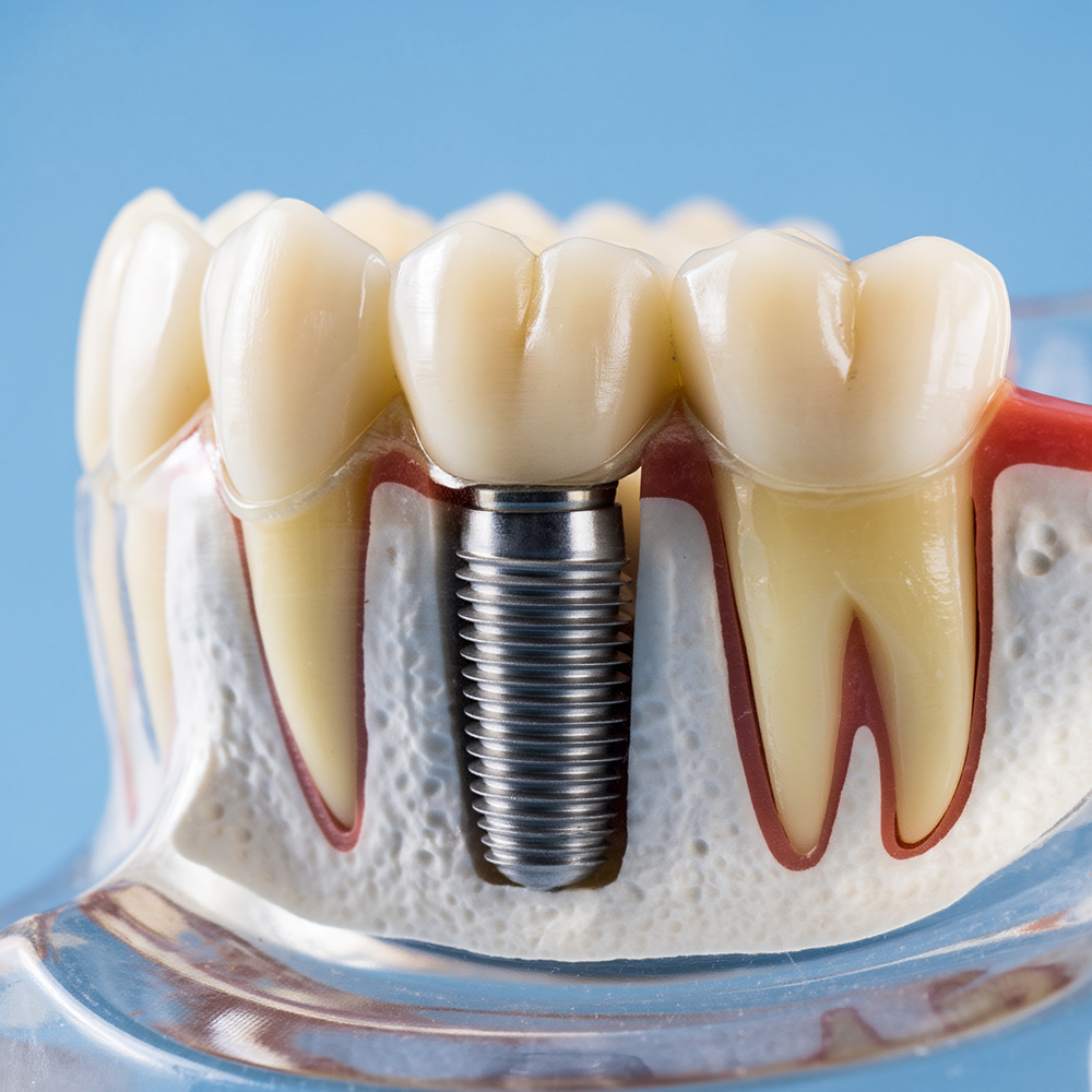 İmplant Tedavisi