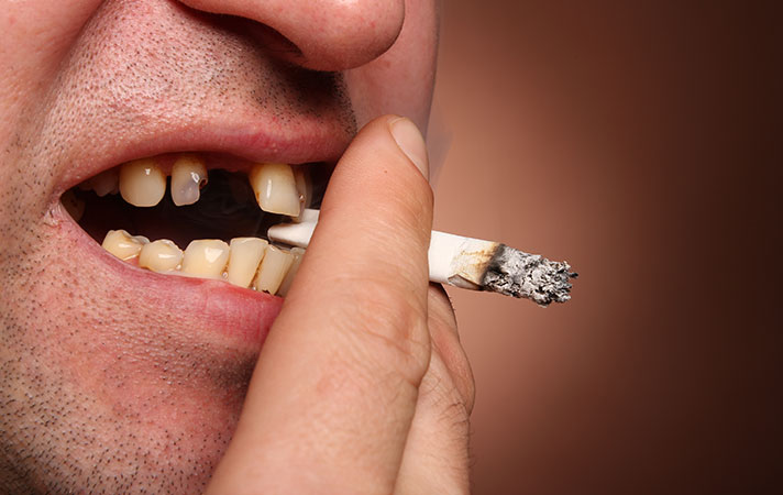 Sigaranın Ağız ve Diş Sağlığına Zararları